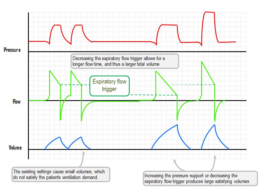 Patientventilator dyssynchrony Deranged Physiology